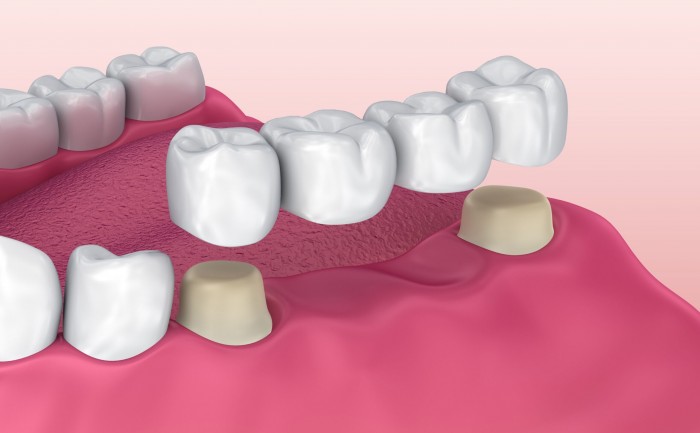 Мостовидные протезы на своих зубах