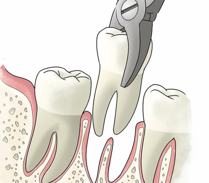 Способы удаления зубов